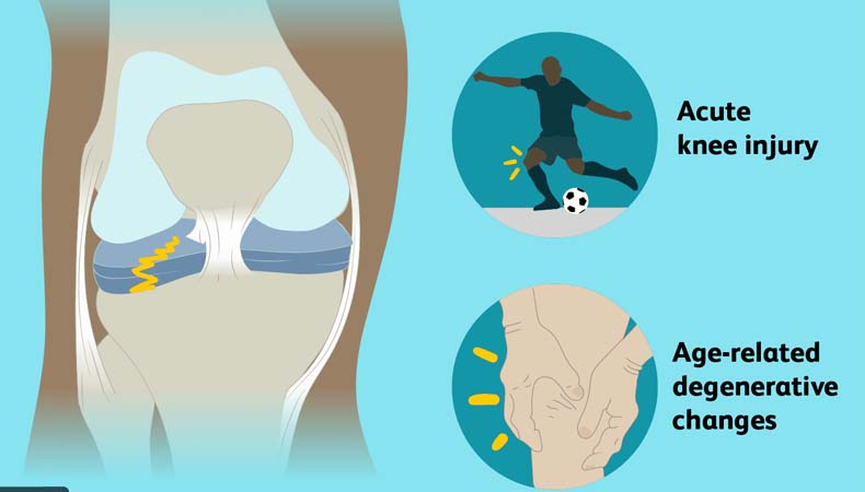 Meniscus Injury